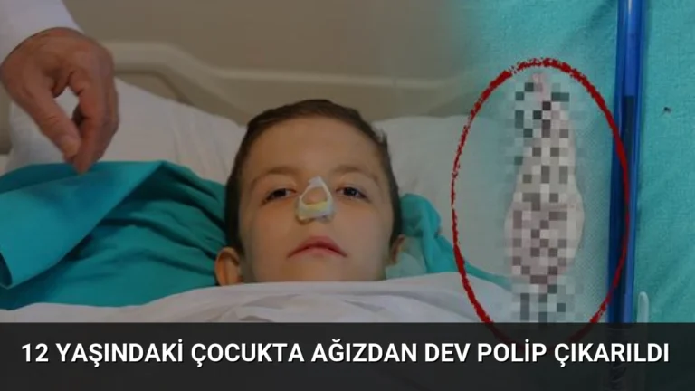 12 Yaşındaki Çocukta Ağızdan Dev Polip Çıkarıldı
